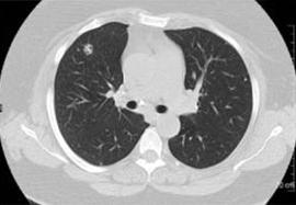 Lung MRI Image