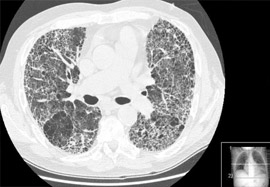 MRI Showing Lung Disease